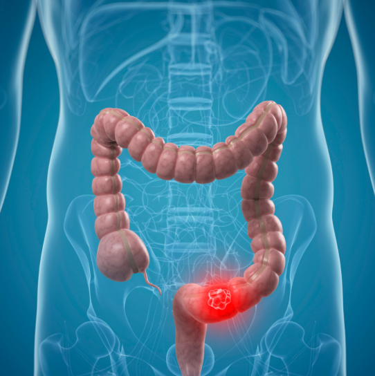 constipação intestinal