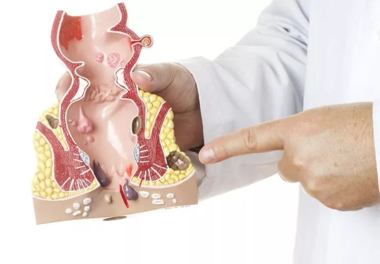 Sangue nas fezes hemorroidas